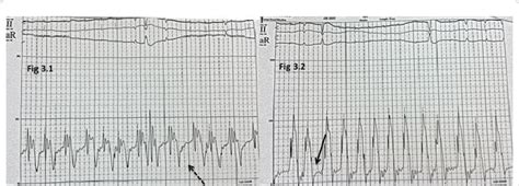 Cardiac catheterization. Figure 3.1: right atrial pressure waveform... | Download Scientific Diagram