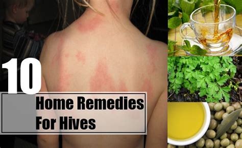 Home Remedies For Hives | Home remedies for hives, Hives remedies, Home ...