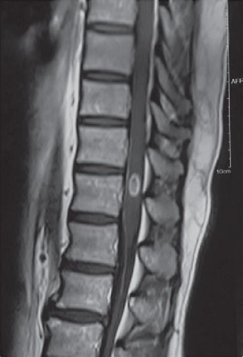 MRI of dorsal-lumbar spine showing an intramedullary ovoid lesion with... | Download Scientific ...