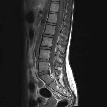 Normal Mri Lumbosacral Spine Image Radiopaedia Org | Hot Sex Picture