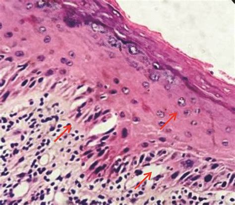 Erythroplakia Histopathology