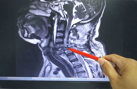 Cervical Spine Curve and Injuries