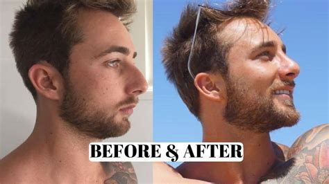 Male Before & After Rhinoplasty, Nose Job 12 weeks post Operation, 12 weeks after - YouTube