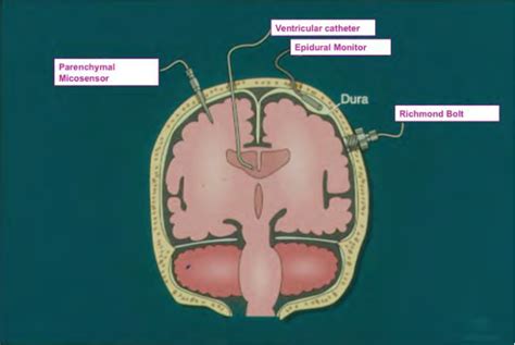 Figure 1 from Management of Increased Intracranial Pressure | Semantic ...