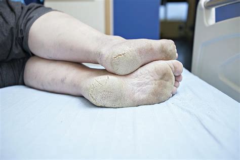 Dry And Cracked Feet In Diabetes Photograph by Lewis Houghton/science ...