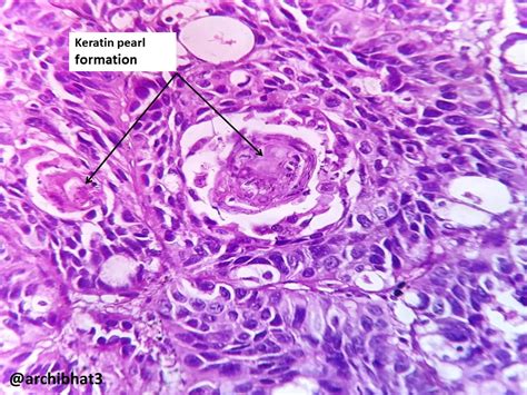 Lung Carcinoma Histology