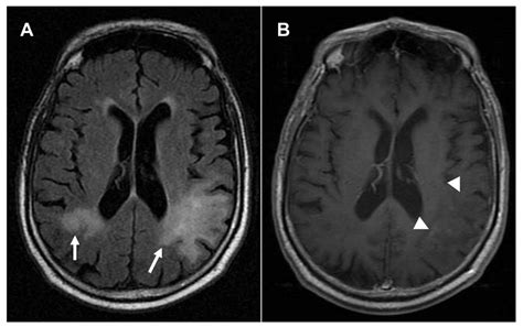 Brain MRI shows multiple PML lesions A Fluid attenuation inversion ...