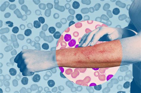 Leukemia Rashes: Types, Causes, Diagnosis and More