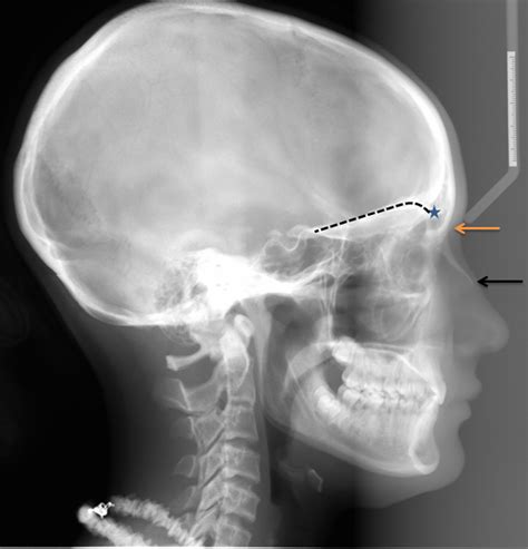 nasion – Dr. G's Toothpix