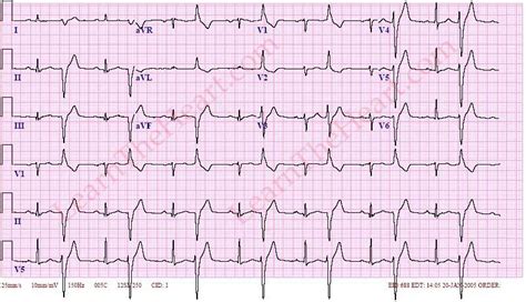 Ventricular Bigeminy ECG (Example 3) | Learn the Heart