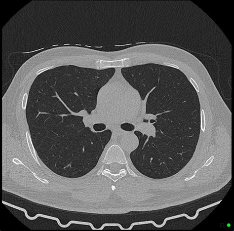 High Resolution Chest Ct Scan