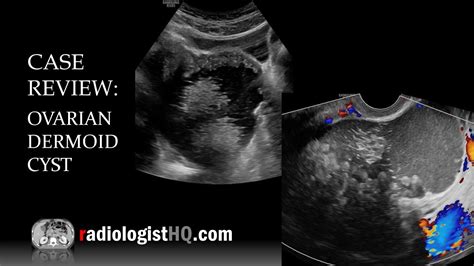 Dermoid Ovarian Cyst Ultrasound