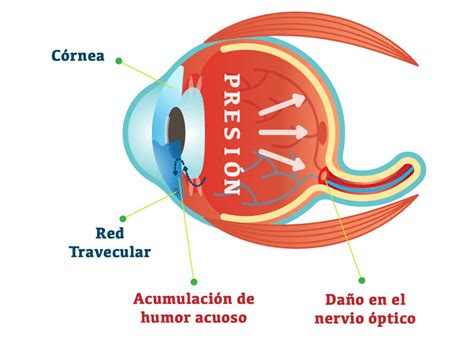 Glaucoma ocular: Definición, causas, síntomas y tratamiento | Vision Direct