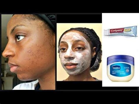 Before And After Using Vaseline For Acne | Before And After