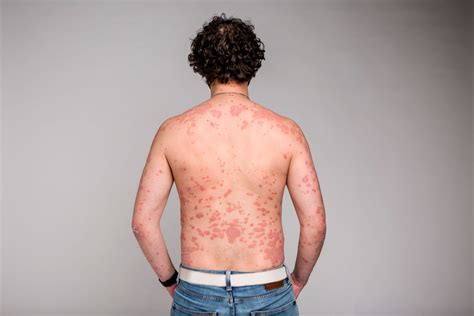 major back psoriasis - Psoriasis Cure Now