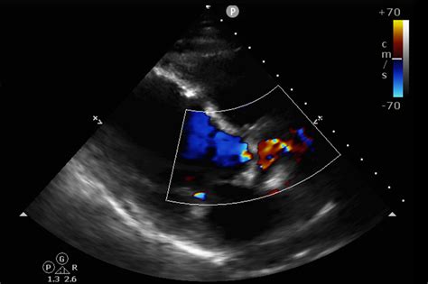 Transesophageal Echocardiogram (TTE) - Cardiovascular Interventions Orlando