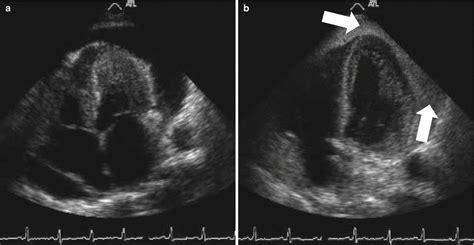 Echo Guided Pericardiocentesis | SpringerLink