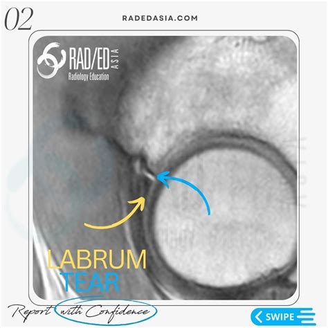 HIP LABRUM LABRAL TEAR MRI RADIOLOGY - Radedasia