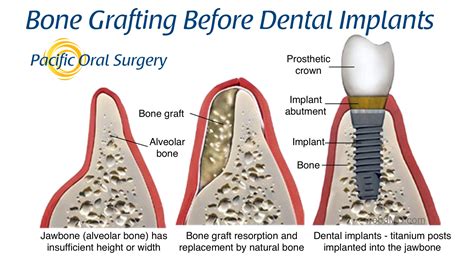 Bone Grafting for Dental Implants at Pacific Oral Surgery