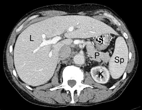 Normal Ct Scan Abdomen