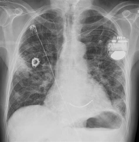 127Lu COPD Pneumonia Atypical Appearance | Lungs