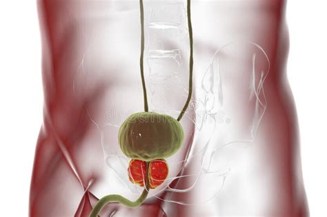 Benign Prostatic Hyperplasia Stock Illustration - Illustration of ...