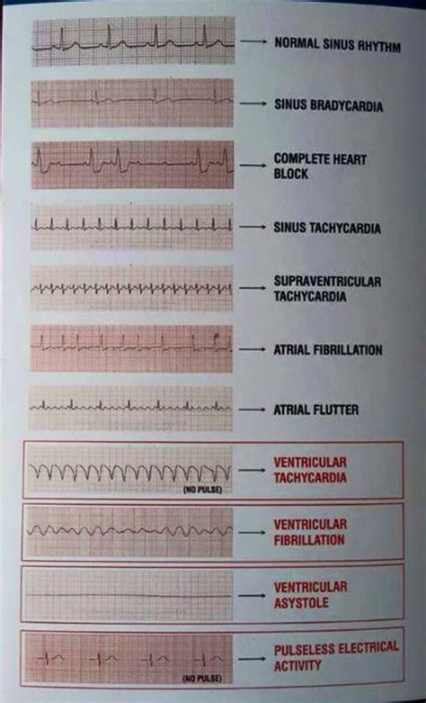 Cheat Sheet Ekg Strips Examples Basic Ekg Ecg Rhythms Cheatsheet ...