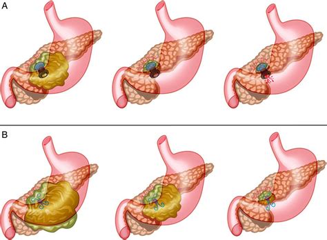 Lumen-apposing metal stents (LAMS) for pancreatic fluid collection (PFC ...