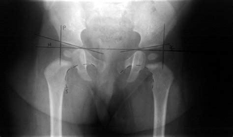 Bone Section: Hip dysplasia