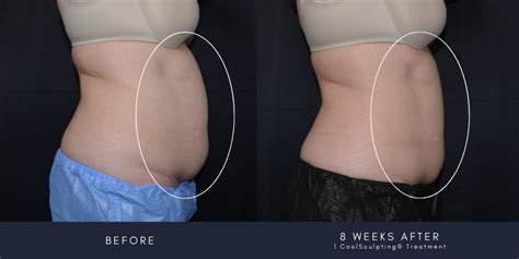 Want to get your CoolSculpting® Elite Results Faster? Here's How: