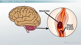 Cerebellar Stroke: Prognosis & Recovery - Video & Lesson Transcript | Study.com