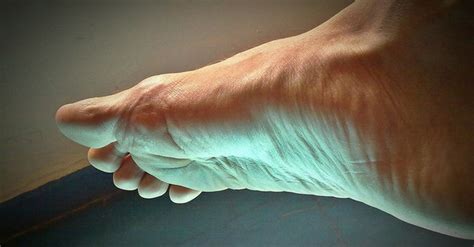 Rheumatoid Arthritis in Feet and Ankles: Symptoms and Treatments | myRAteam