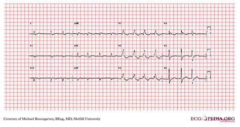 Atrial fibrillation EKG examples - wikidoc