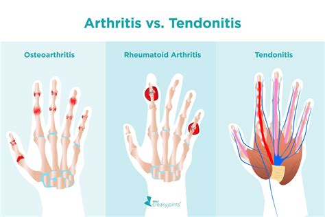 Diferencias Entre Tendinitis Y Tendinosis | Porn Sex Picture