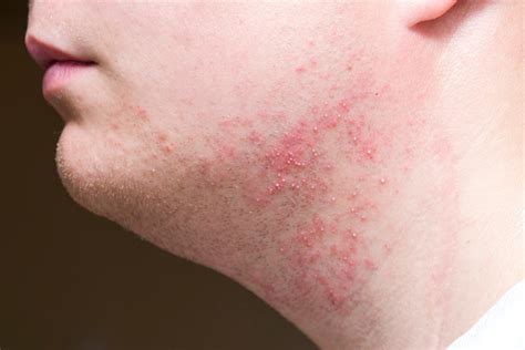 Irritation After Shaving On The Neck Of A Man Closeup Stock Photo ...