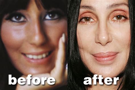 Cher plastic surgery Before and After Botox and Nose Jobs (Star plastic surgery)