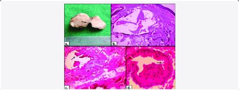 Ceruminous adenoma depicting a nodular tumefaction with glandular... | Download Scientific Diagram