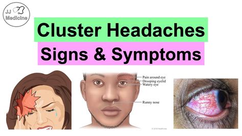 Cluster Headaches Symptoms, Associated Issues & Triggers - YouTube