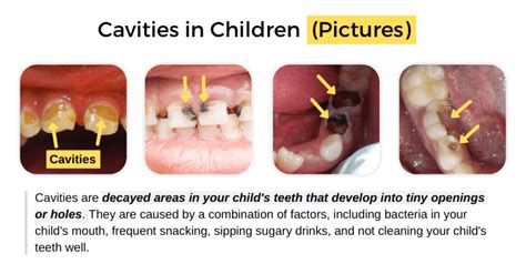 Cavities in Children - Share Dental Care