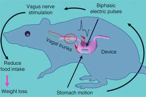 Implantable Vagus Nerve Stimulation Device Aids Weight Loss | Sci.News