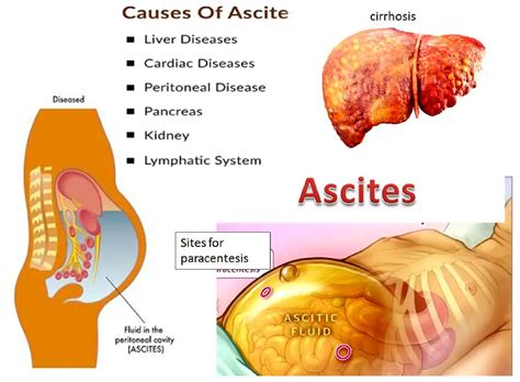 Ascites cause, grades, symptoms, diagnosis and Treatment of cirrhotic ...