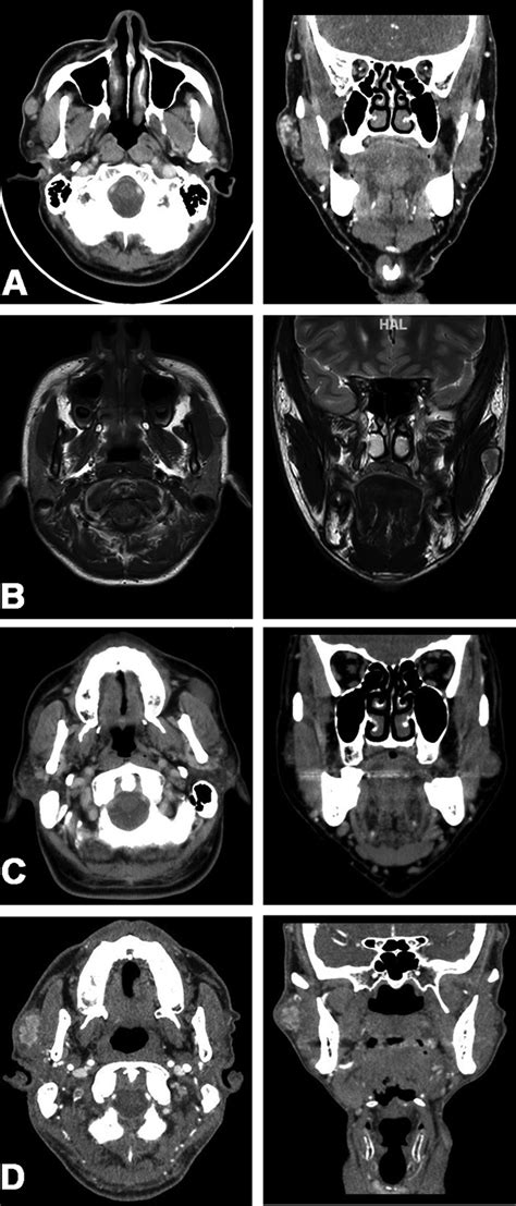 Imaging diagnosis of APG tumors. (A) CT scan of pleomorphic adenoma ...