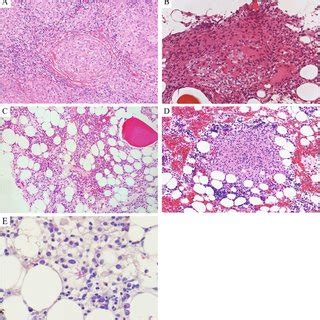 Histopathological analysis of the cervical lymph node biopsy (a) and ...