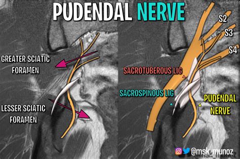 Pudendal Nerve Mri