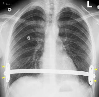 RiT radiology: Nuss Procedure for Pectus Excavatum