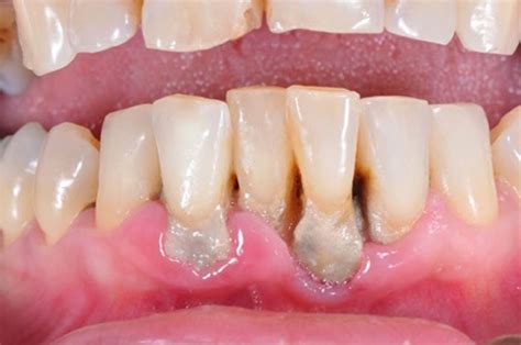 Scientists discover possible new weapon in the fight against gum disease - Bite Magazine