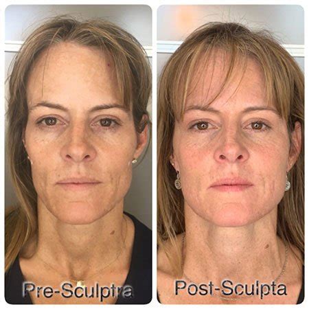 Sculptra® Aesthetic Collagen-Regenerating Injections – Adore Aesthetix