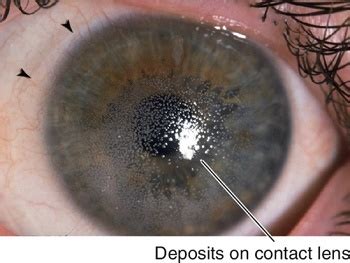 Top 15 Causes of Contact Lens Irritation - Contacts Advice