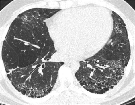 IDIOPATHIC PULMONARY FIBROSIS (IPF) | IAG