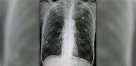 Emphysema causes and symptoms | Respiratory tract disorders and ...